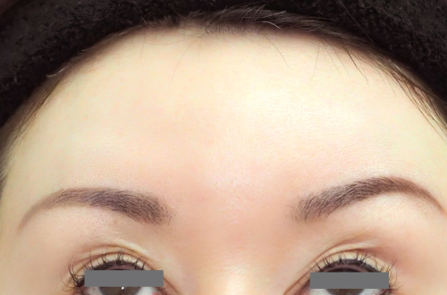 表情ジワのボトックス注射(40代|女性)2週間後