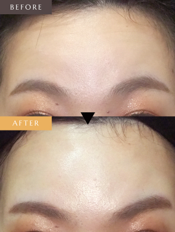 表情ジワのボトックス注射（額）