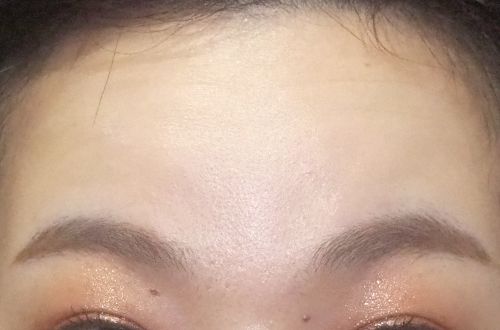 表情ジワのボトックス注射(30代|女性)