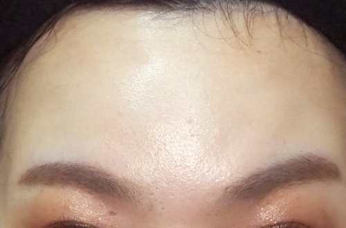 表情ジワのボトックス注射(30代|女性)2週間後