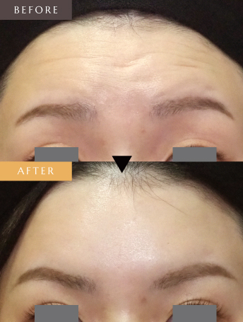 表情ジワのボトックス注射（額）