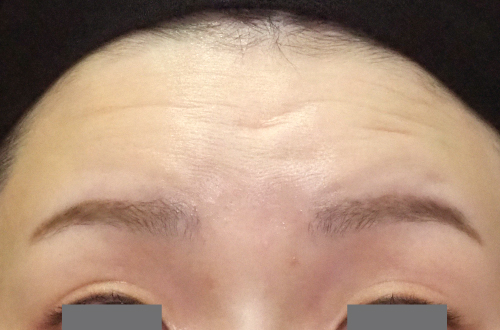 表情ジワのボトックス注射（30代｜女性）