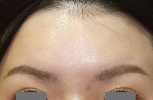 表情ジワのボトックス注射（30代｜女性）2週間後