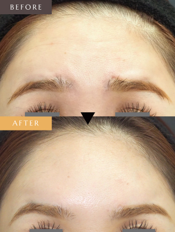 表情ジワのボトックス注射（額）