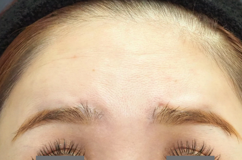 表情ジワのボトックス注射（20代｜女性）