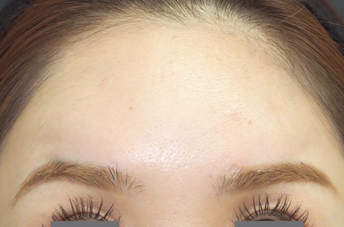 表情ジワのボトックス注射（20代｜女性）2週間後