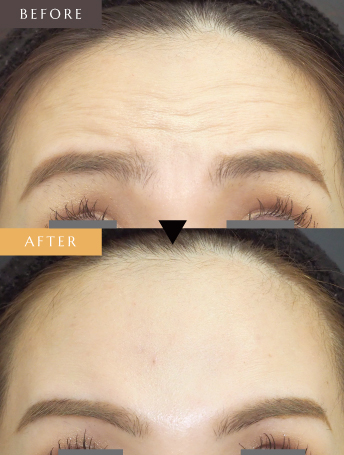 表情ジワのボトックス注射（額）