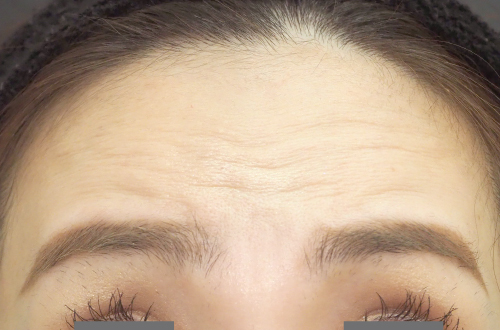 表情ジワのボトックス注射（30代｜女性）