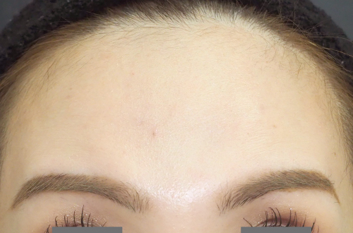 表情ジワのボトックス注射（30代｜女性）2週間後