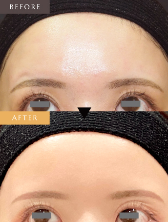 表情ジワのボトックス注射（額）