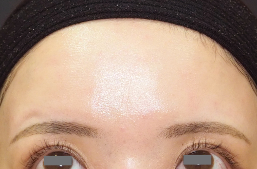 表情ジワのボトックス注射（20代｜女性）