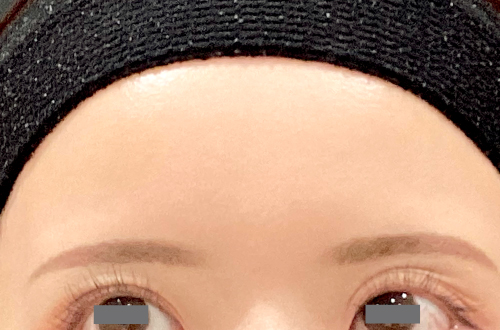 表情ジワのボトックス注射（20代｜女性）2週間後