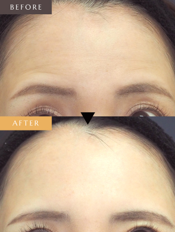 表情ジワのボトックス注射（額）