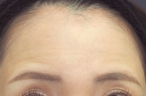 表情ジワのボトックス注射（30代｜女性）