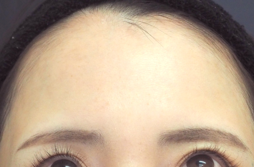 表情ジワのボトックス注射（30代｜女性）2週間後