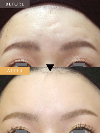 表情ジワのボトックス注射（額）