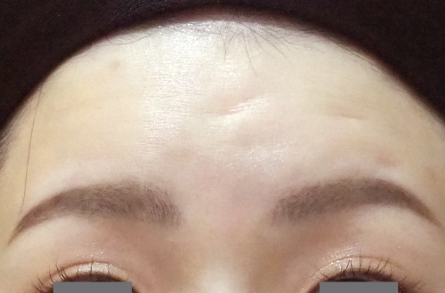 表情ジワのボトックス注射（20代｜女性）