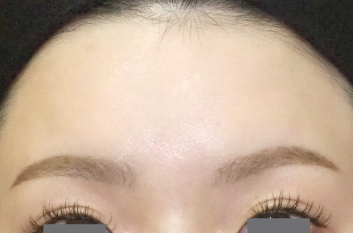 表情ジワのボトックス注射（20代｜女性）2週間後