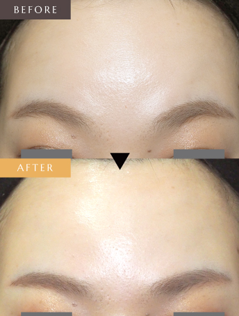 表情ジワのボトックス注射（額）