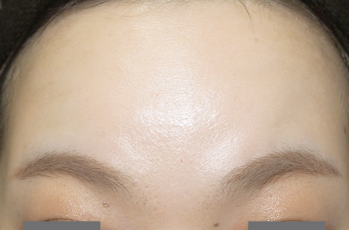 表情ジワのボトックス注射（30代｜女性）