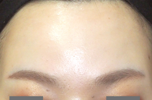 表情ジワのボトックス注射（30代｜女性）2週間後