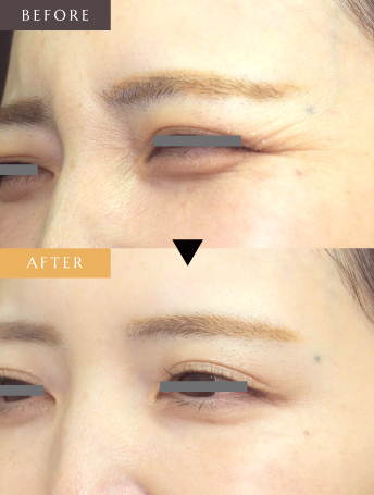 表情ジワのボトックス注射（目尻）