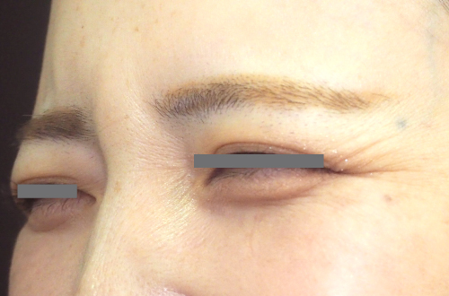 表情ジワのボトックス注射(30代|女性)