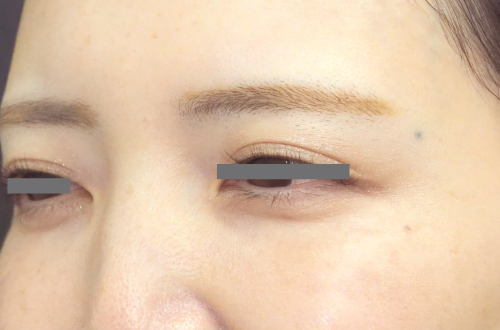 表情ジワのボトックス注射(30代|女性)2週間後