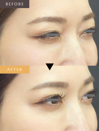 表情ジワのボトックス注射（目尻）