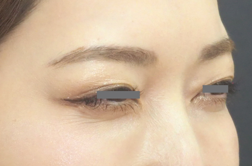 表情ジワのボトックス注射(30代|女性)