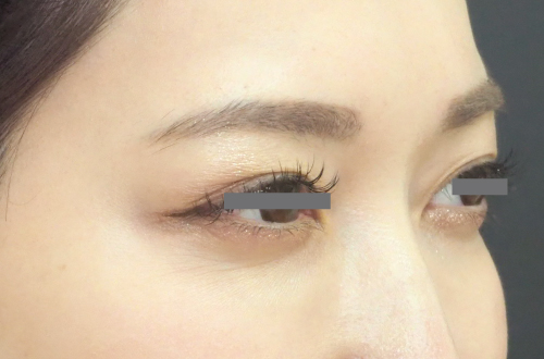 表情ジワのボトックス注射(30代|女性)2週間後