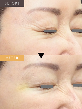 表情ジワのボトックス注射（目尻）