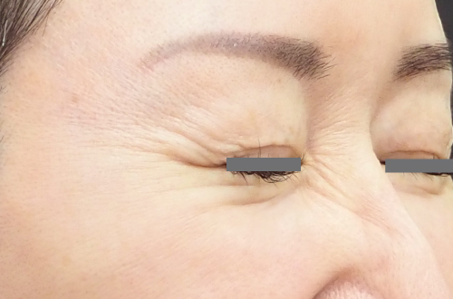 表情ジワのボトックス注射（40代｜女性）