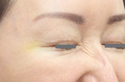 表情ジワのボトックス注射（40代｜女性）2週間後