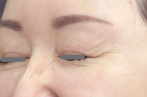 表情ジワのボトックス注射（40代｜女性）