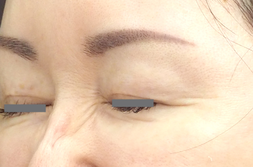 表情ジワのボトックス注射（40代｜女性）2週間後