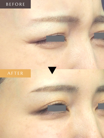 表情ジワのボトックス注射（目尻）