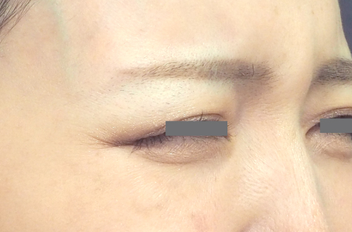 表情ジワのボトックス注射（30代｜女性）