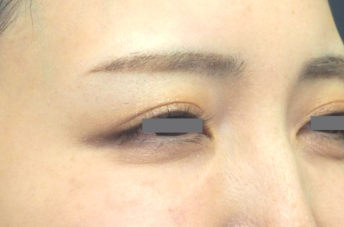 表情ジワのボトックス注射（30代｜女性）2週間後