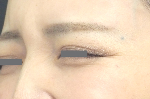 表情ジワのボトックス注射（30代｜女性）