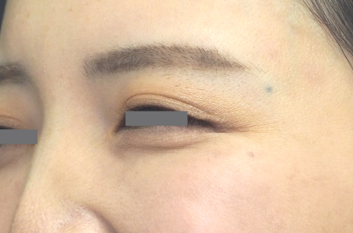 表情ジワのボトックス注射（30代｜女性）2週間後