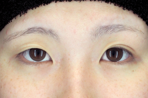 二重埋没法(10代|女性)