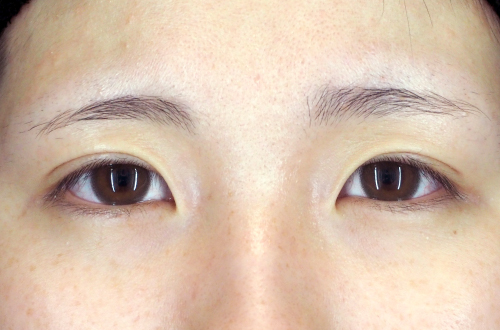 二重埋没法(10代|女性)3ヶ月後