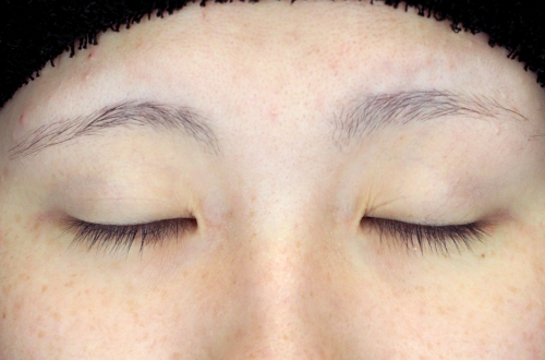 二重埋没法(10代|女性)