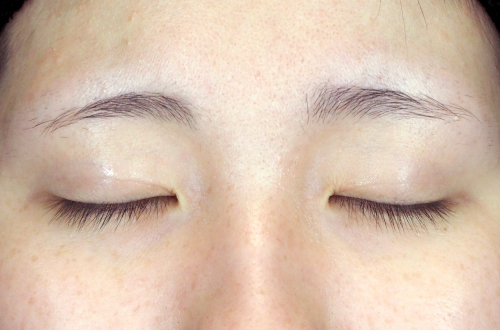 二重埋没法(10代|女性)3ヶ月後