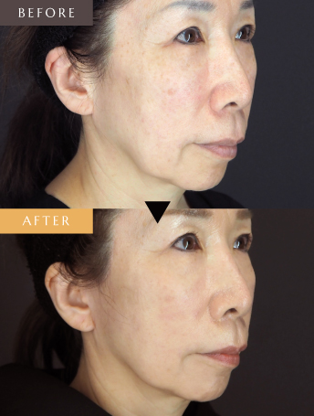 フルフェイスリフト