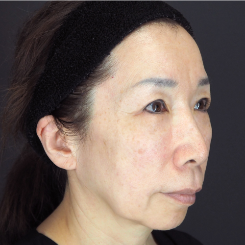 フルフェイスリフト（50代以上｜女性）