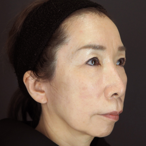 フルフェイスリフト（50代以上｜女性）6ヶ月後