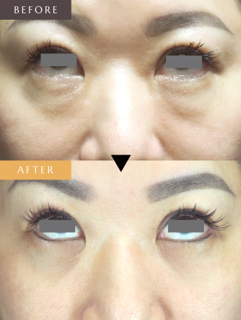 目の下の脂肪取り（結膜法）