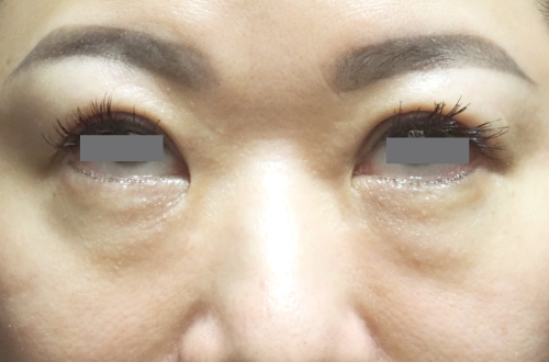 目の下の脂肪取り（40代｜女性）